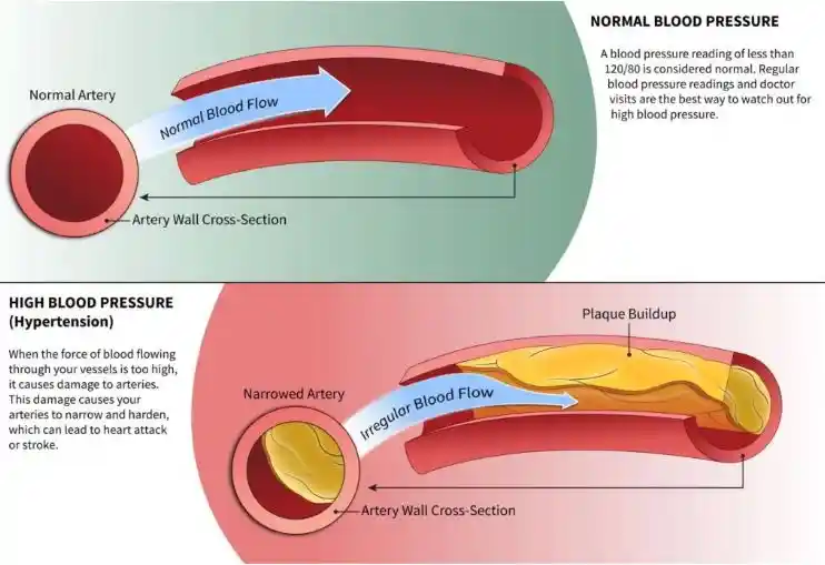 high blood pressure and ed