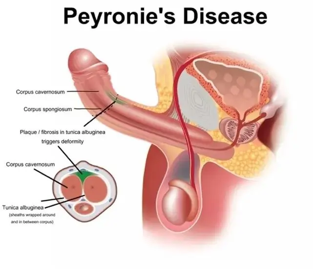 Peyronies Disease