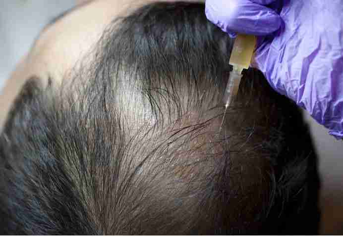 Stem Cells Hair Therapy Kona